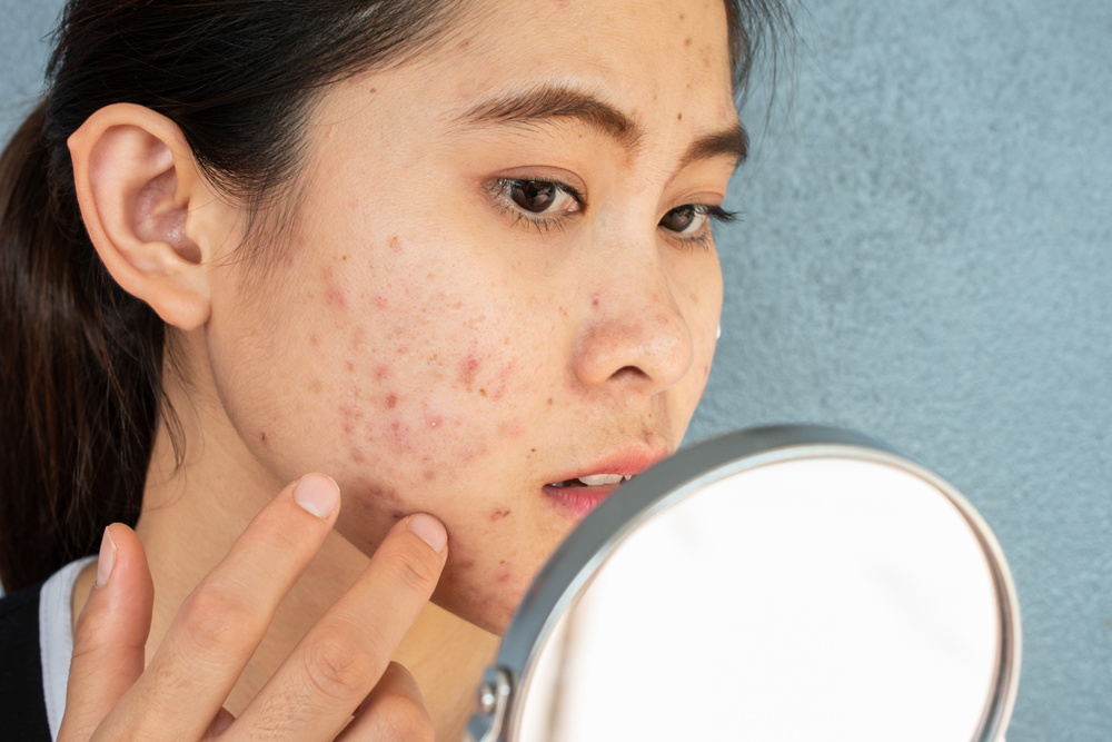 Portrait of Asian woman worry about her face when she saw the problem of acne inflammation and scar by the mini mirror